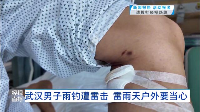 九游娱乐文化：武汉男子雨天一个动作引来闪电……医生：已救治多例！(图2)
