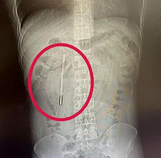 12岁男孩误吞体温计怕被骂隐瞒20年！揭开家庭教育最大的失败(图1)